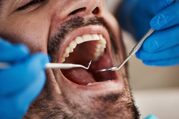 Dental Inlays and Onlays in Manheim, PA